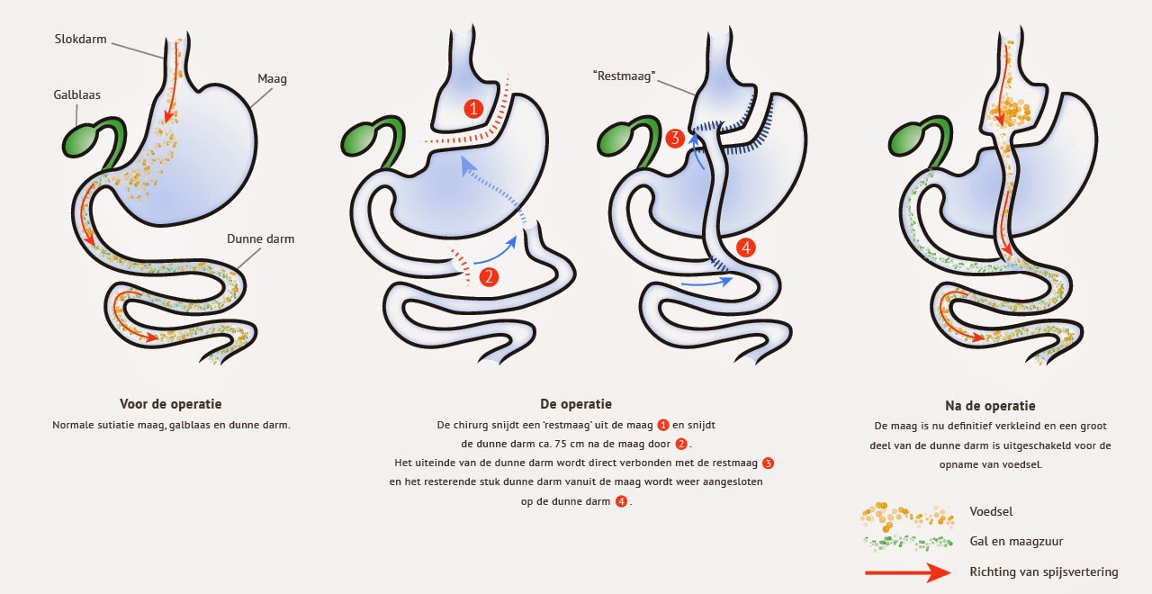 Het Gevecht tegen Obesitas Operatie om