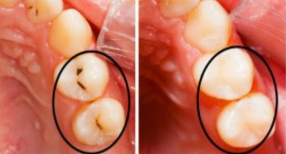 Clever And Healthy How To Fill Cavities Without Going To The Dentist