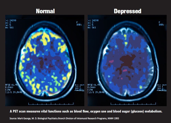 Does depression cause brain damage? Does it make you dumber?