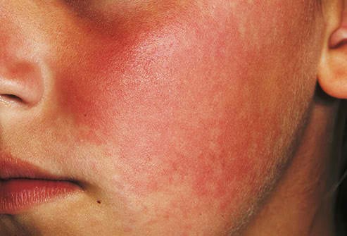 Strep Rash or Viral Scarlatina Rash - Healthy Skin Care