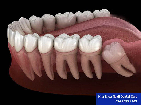 Nhổ răng khôn có đau không vậy mọi người