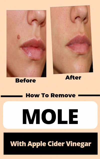 Apple Cider Vinegar Mole Removal Naturally | Healthy Hard
