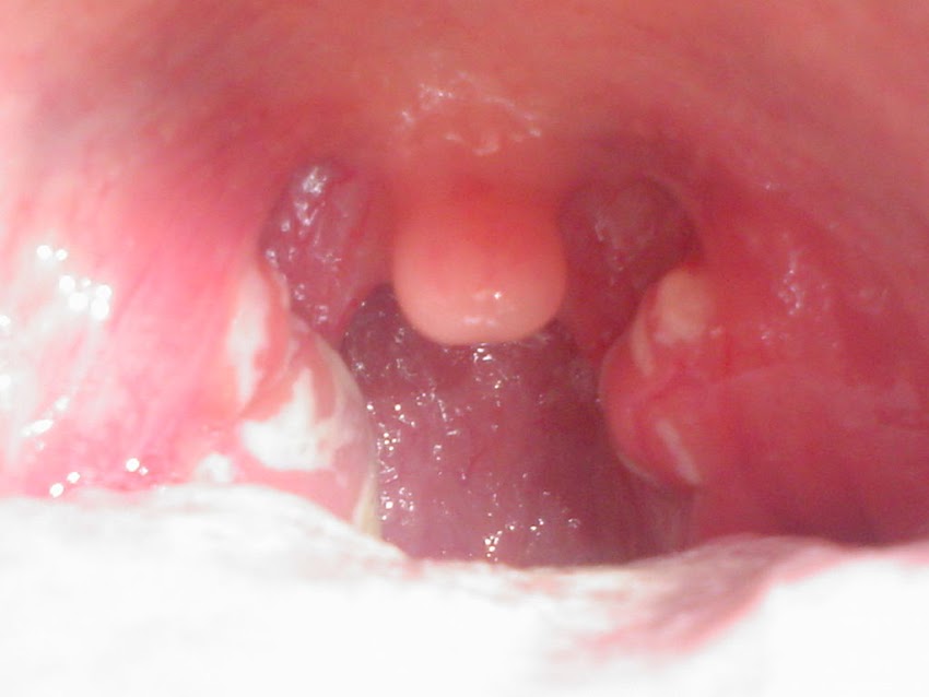 STREPTOCOCCAL PHARYNGITIS