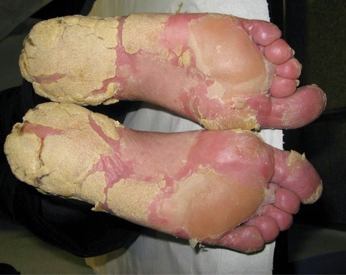 8 Common Foot Problems - Skin Problems Center: Medical ...