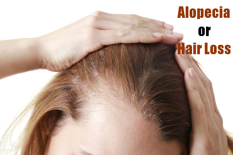 A Comprehensive Guide To Alopecia: Everything You Need To Know.