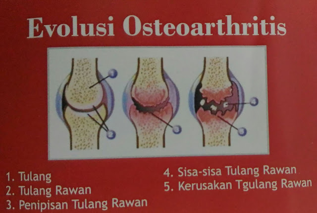 Tahapan atau proses Osteoarthritis pada persendian