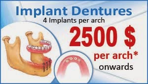 Implant Dentures Delhi India