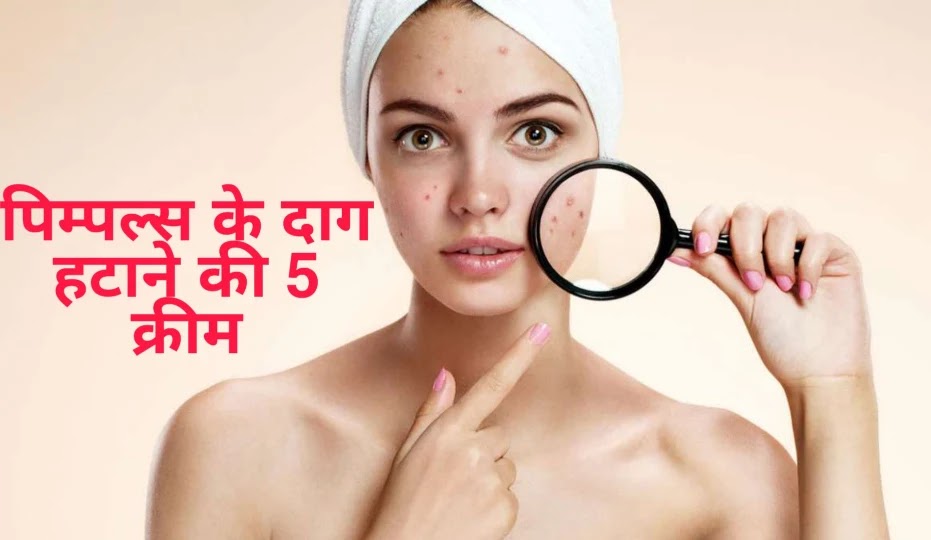 पिम्पल्स के दाग हटाने की 5 क्रीम