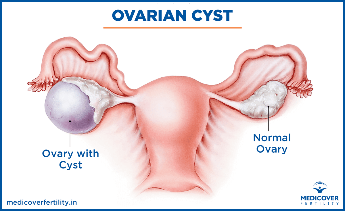 Women's Diseases (Cysts, Fibroids, Polyps and Endometriosis) on Womb