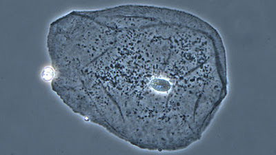 célula de cáncer vista desde un microscopio