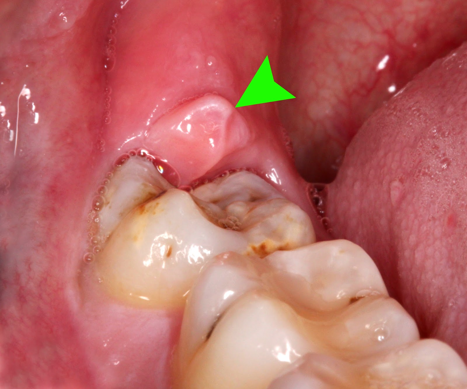 Gonflement des gencives à l'arrière de la bouche