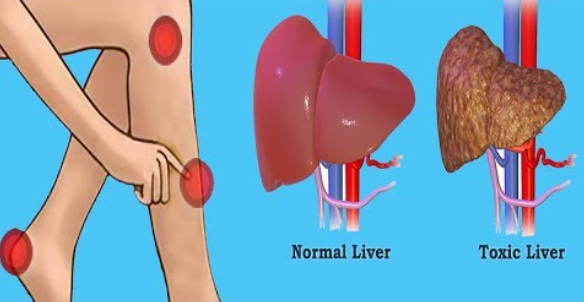 11 WAYS YOUR TO TELL YOU THAT YOUR LIVER IS BEING DAMAGED