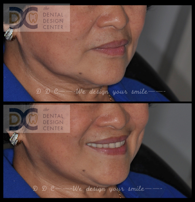 Full mouth implants in severe maxillary resorbed ridge 38 Screen%2BShot%2B2560 02 02%2Bat%2B6.58.40%2BAM