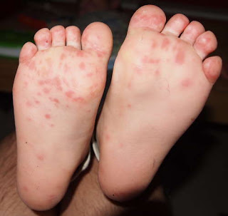 Both patient's feet have rashes pics