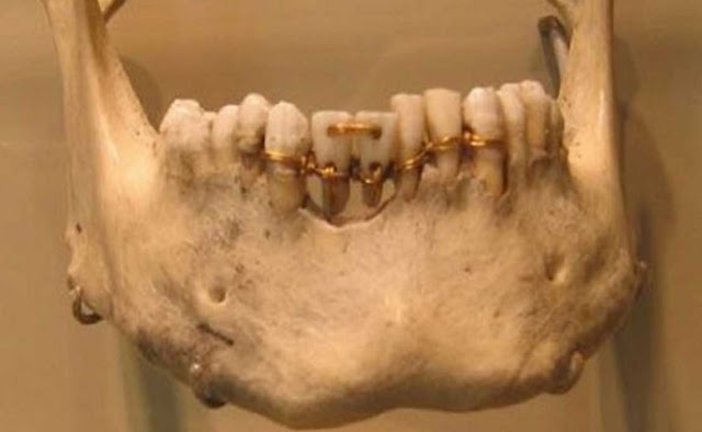Зубные протезы Древнего Египта