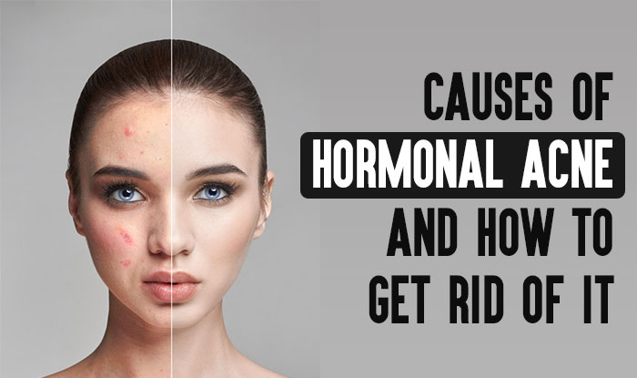 Causes of Hormonal Acne and How to Get Rid of it
