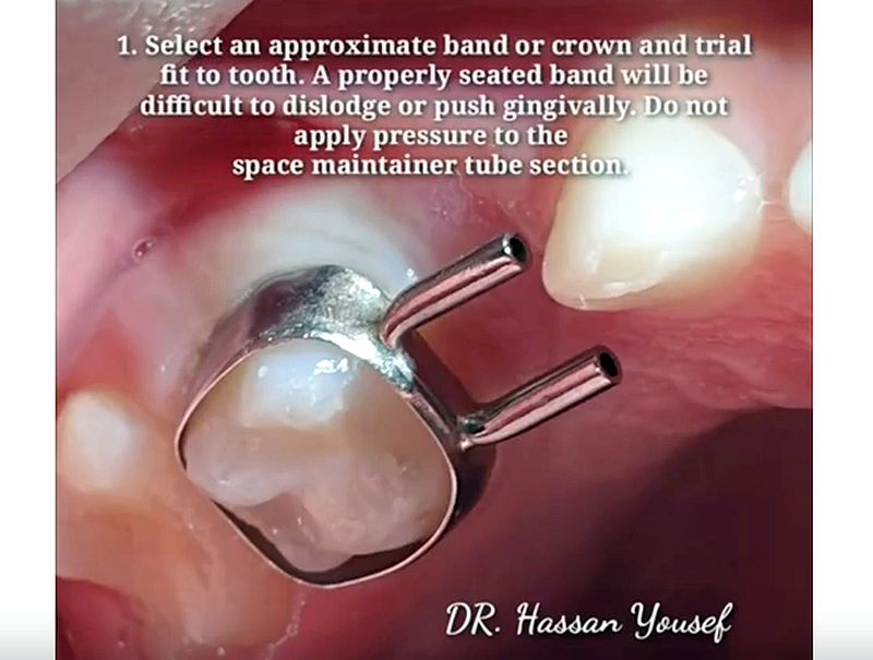 SPACE MAINTAINER System Application Procedures Dr Hassan Yousef