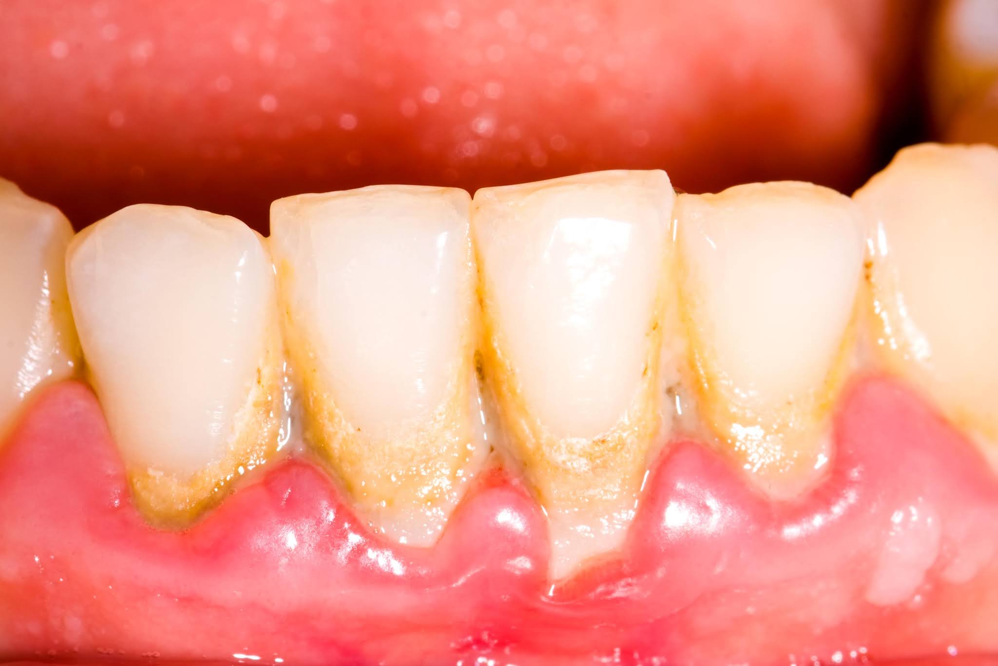 The Truth About Dental Plaques
