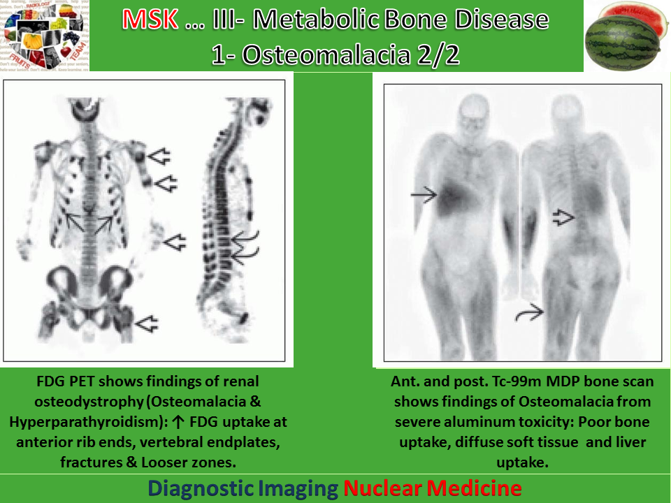 Easy Radiology Metabolic bone disease