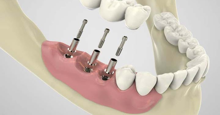 When Dental Implant Treatments is required?