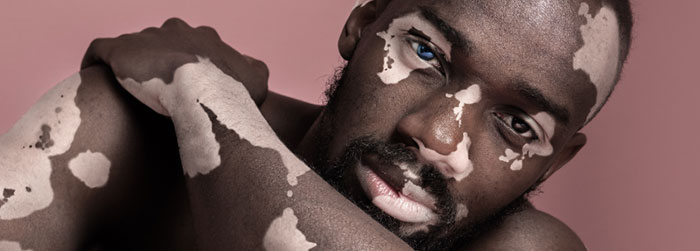 Vitiligo
