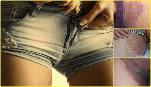 cara mengobati gatal di selangkangan parah/Tak kunjung sembuh cara mengobati gatal di selangkangan parah/Tak kunjung sembuh