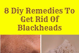 8 Diy Remedies To Get Rid Of Blackheads