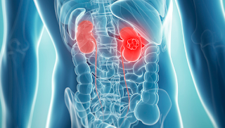 Kidney Cancer Symptoms