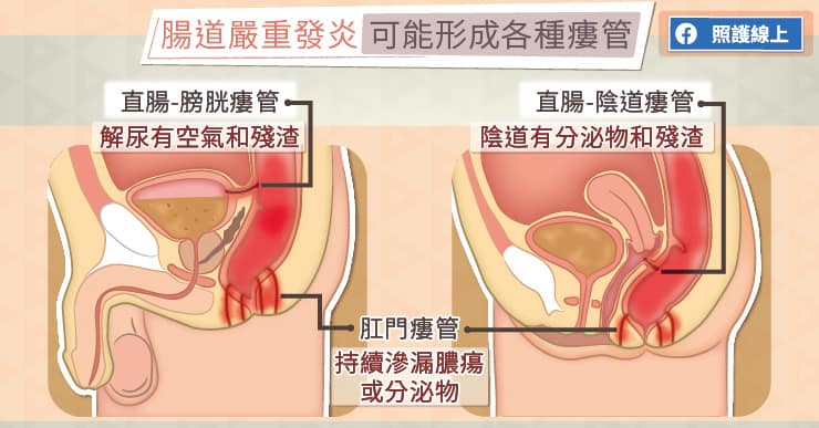 腸道嚴重發炎，可能形成各種瘻管