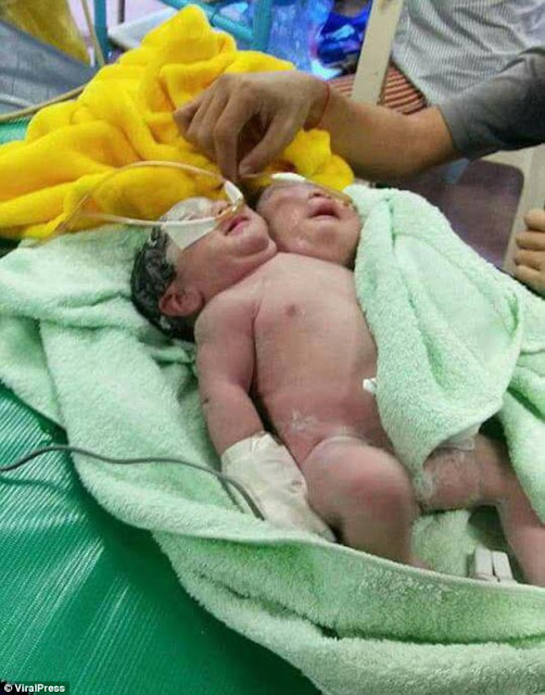 Lahir Bayi Kembali Dengan 2 Kepala Kondisinya Normal, Namun Kasihan Orang Tuanya Lahir Bayi Kembali Dengan 2 Kepala Kondisinya Normal, Namun Kasihan Orang Tuanya