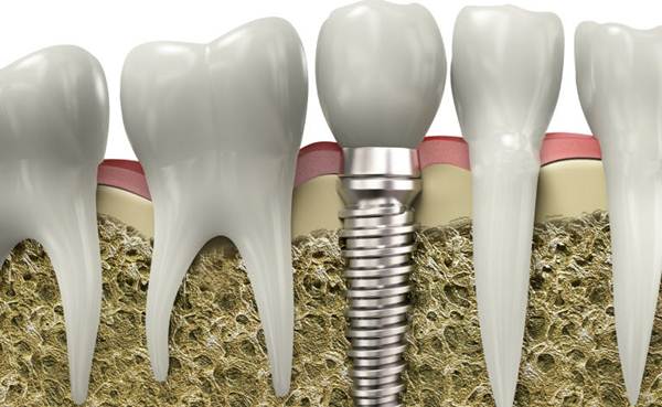  Mungkin anda gila mendengar kata implan gigi 4 Fakta Implan Gigi yang Mesti Diketahui