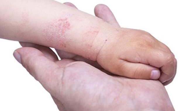 5 penyakit kulit ini ternyata bisa disebabkan karena smartphone