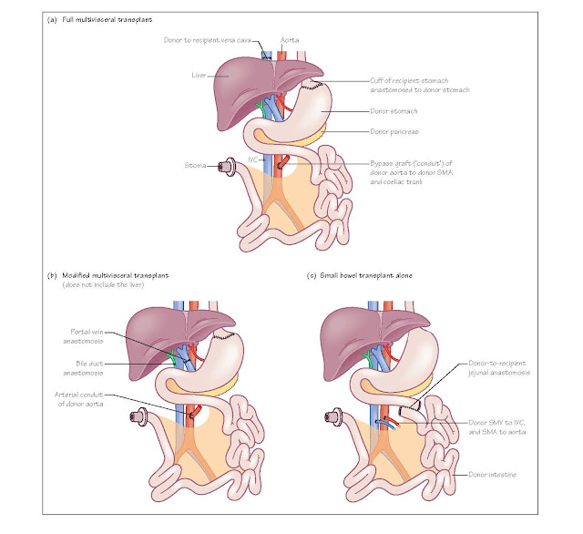 Intestinal Transplantation, Multivisceral transplant, 