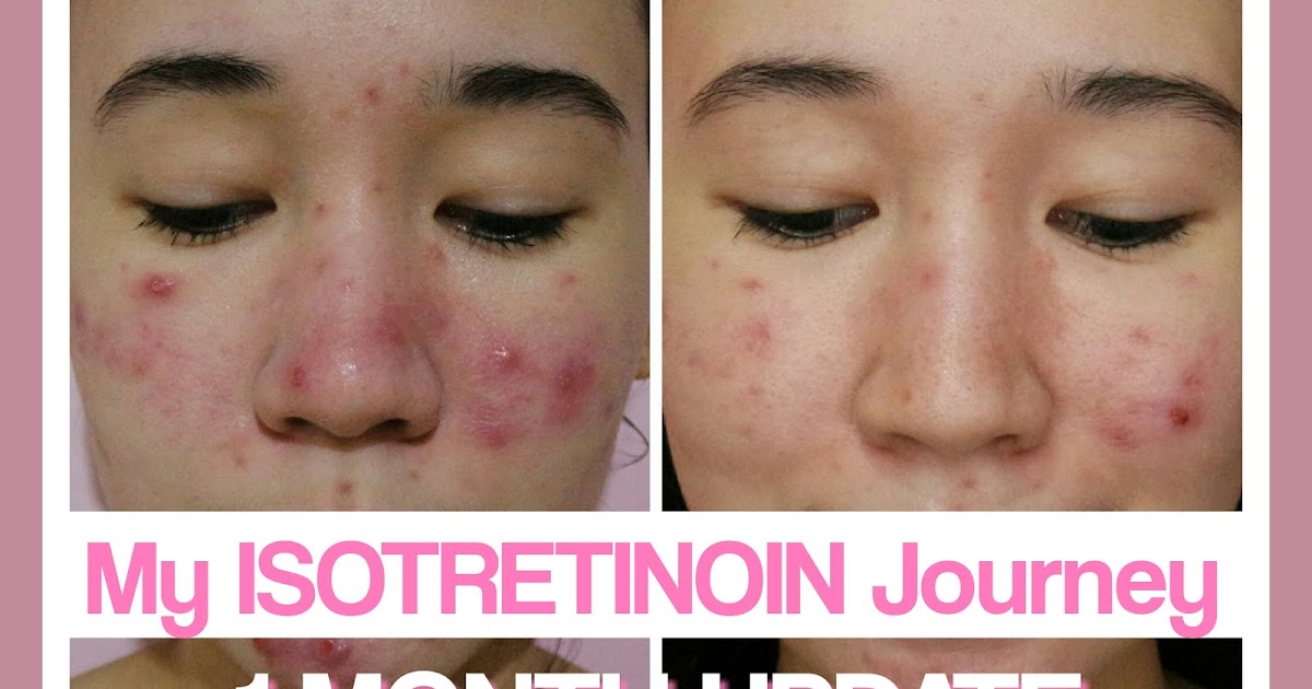 My ISOTRETINOIN JOURNEY (ACNOTIN/ACCUTANE) 1 MONTH SKIN UPDATE pinkislovebynix