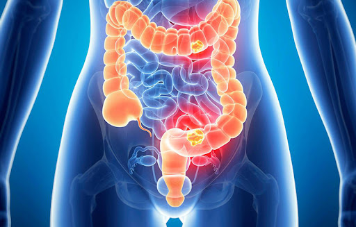 Salud y Nutrición Celular: LA MUERTE EMPIEZA EN EL COLÓN
