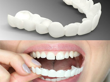 عدسات تبييض الأسنان تجربتي