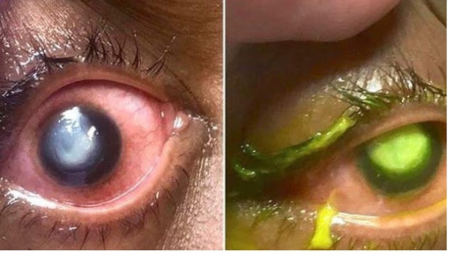 Gara-gara Tidur Pakai Soft Lens, Kornea Mata Wanita Ini Membusuk Digerogoti Bakteri