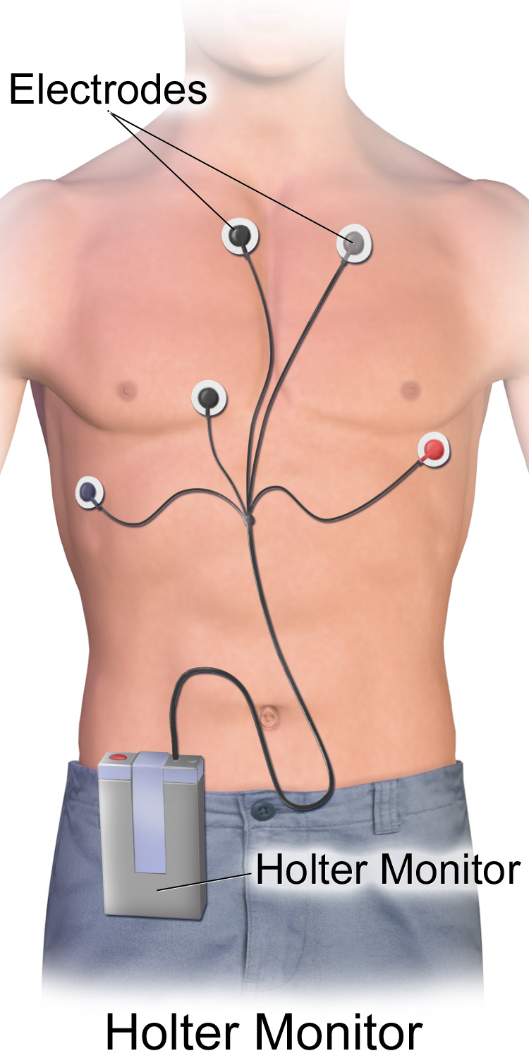 Holter Monitor