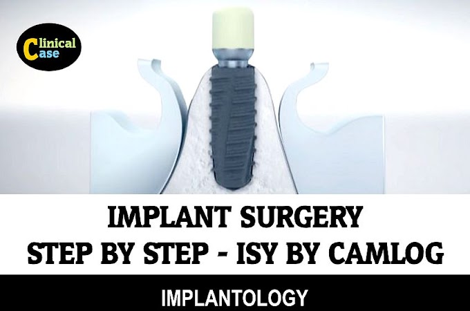IMPLANT SURGERY: Step by Step - Isy by Camlog