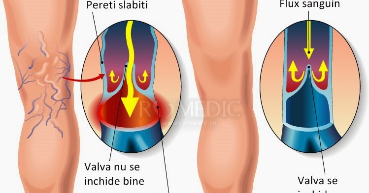 oetul apple beneficiaza de varicoza