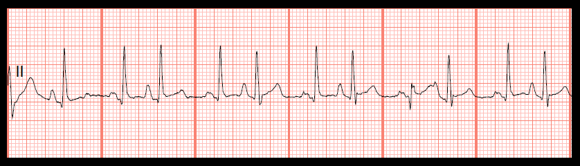 Various Rhythms with PACs