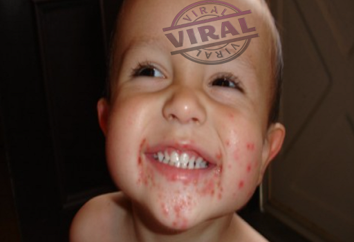 Hand foot and mouth disease Diagnosis and treatments - Viral Of World