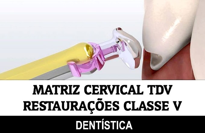 MATRIZ CERVICAL TDV - Restaurações classe V