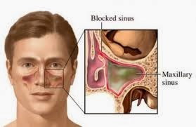 Obat Sinusitis Kronis