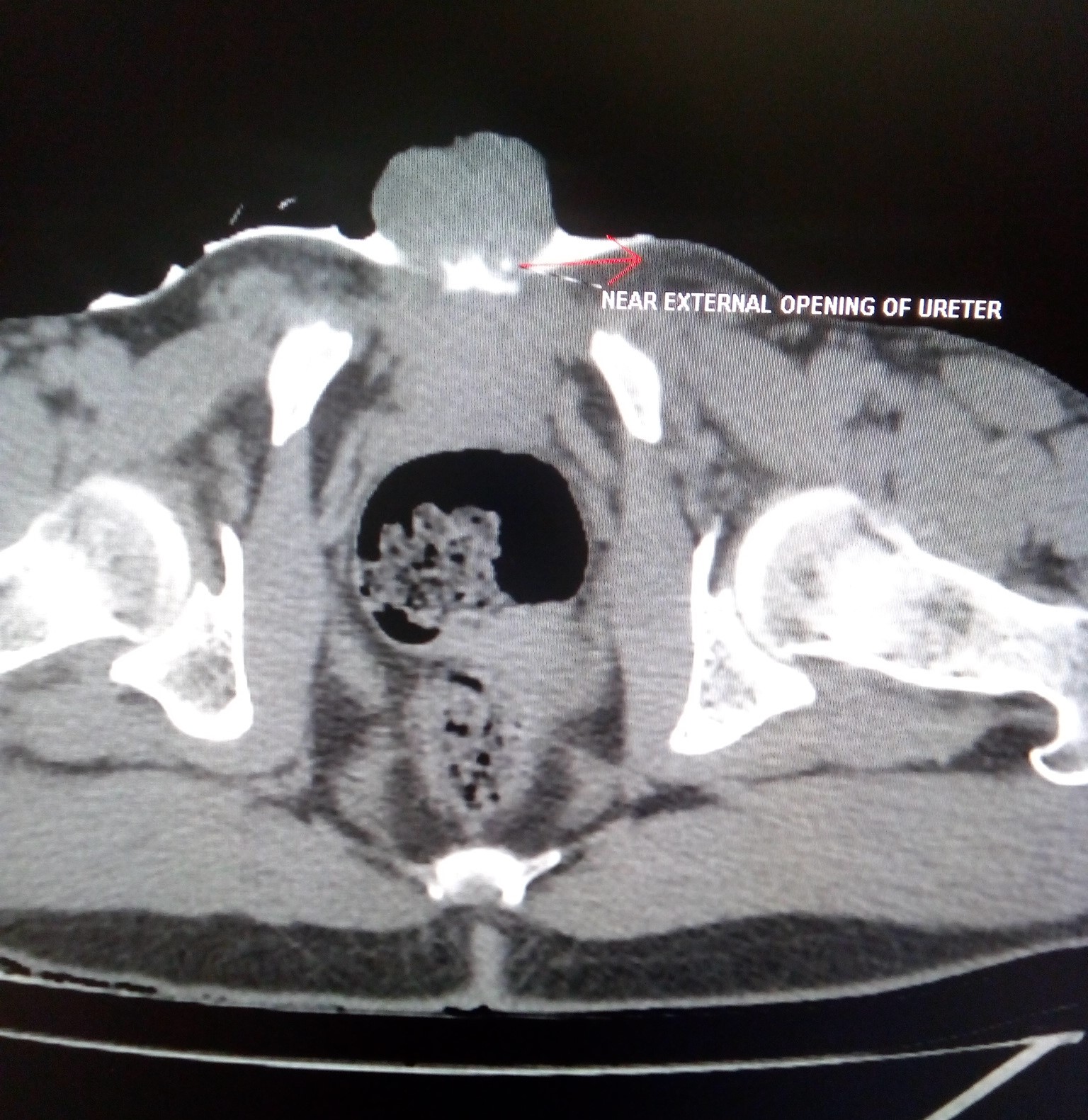 Bladder exstrophy CT Sumer's Radiology Blog