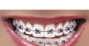 braces teeth whiten bra