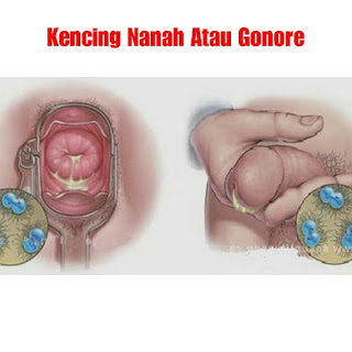 https://amirsr.blogspot.com/2019/11/obat-kencing-nanah-de-nature.html