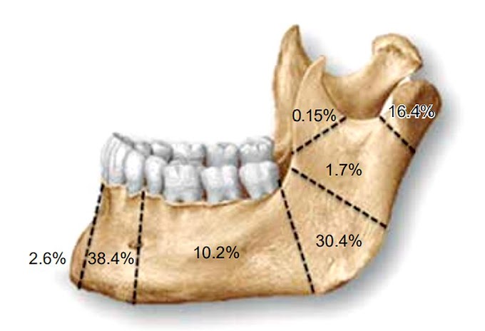 PDF: Incidencia de fracturas mandibulares en Cirugía Bucal y Maxilofacial. Revisión de 634 casos en 493 pacientes