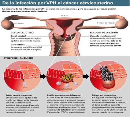Cancer cervicouterino provocado por VPH