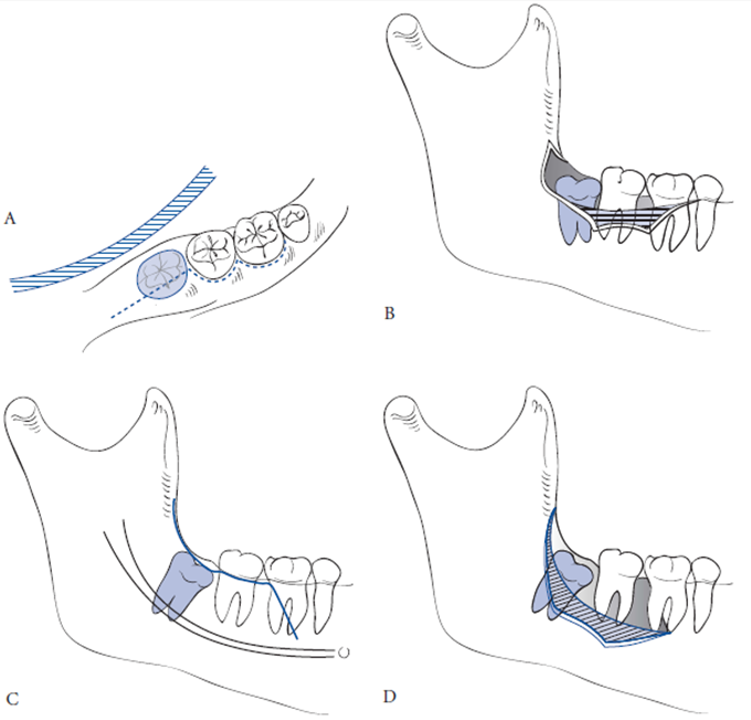 PROCEDIMENTO CIRÚRGICO PARA REMOÇÃO DE DENTES